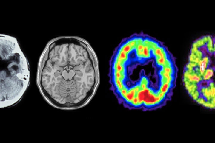 知っておきたい認知症の画像診断